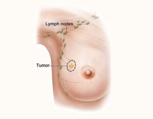 linfonodo sentinella